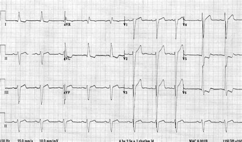 lv side voltage|left ventricular hypertrophy voltage.